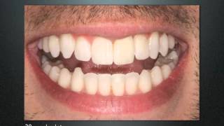 Inman Aligner Video [upl. by Ardied]