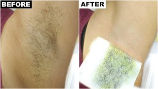 Dark Underarms amp Armpit Hair Removal  BEST amp PERMANENT Solution  Anaysa [upl. by Narmi]