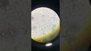 Budding Yeast Cells and High Pus Cells in Urine UNDER MICROSCOPE [upl. by Ardnik]