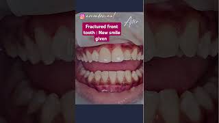 Fractured front tooth Composite build upPainless dentistry [upl. by Petrine]