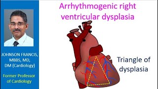 Arrhythmogenic right ventricular dysplasia [upl. by Dowell]