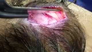 Migraine Surgery Zygomaticotemporal Nerve Decompression Jason Mussman MD FACS [upl. by Ennahs]