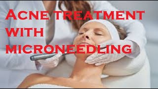 Acne treatment with microneedling [upl. by Alur657]