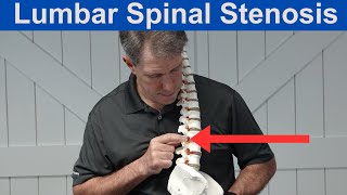 What is Lumbar Spinal Stenosis [upl. by Drolyag]