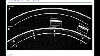 LoVC Course on Therapeutic Corneal Refractive Surgery Part 1 of 6 Diagnostics [upl. by Idoux]