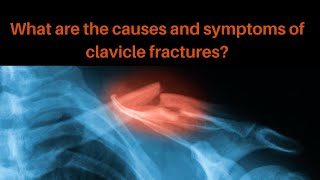 What are the common causes and symptoms of a clavicle fracture [upl. by Spanos517]