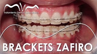 TODO SOBRE LOS BRACKETS ZAFIRO  ¿YA TE DECIDISTE [upl. by Ybba696]