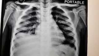 Right sided hepatomegaly or pleural effusion [upl. by Chap429]