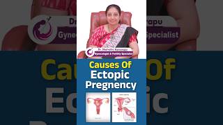 Causes of Ectopic Pregnancy Understanding the Risks and Prevention  shorts ectopicpregnancy [upl. by Ijnek]