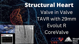 Valve in Valve TAVR with 29mm Evolut R CoreValve  January 8 2019 [upl. by Vallo]