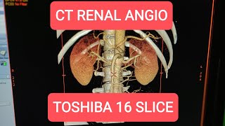 CT Renal Angiogram on Toshiba 16 Slice [upl. by Kurt]