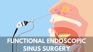 What is a Functional Endoscopic Sinus Surgery [upl. by Sarazen293]