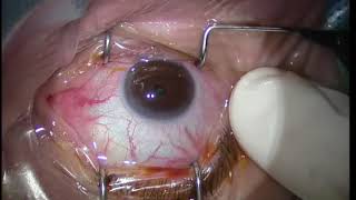 Lucentis Intravitreal Injection Technique for maculopathy [upl. by Garling]