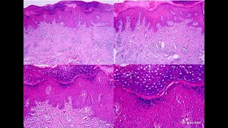 Dermpath SelfAssessment Quiz 030422 Lichen Simplex chronicus [upl. by Inavoig521]