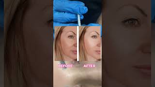 Botox For Eye Wrinkles  Botox Treatment in Banani  Gulshan  Dhaka  Aesthetic Skin Treatment [upl. by Efron7]