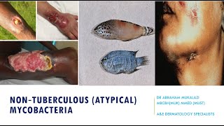 NON TUBERCULUS MYCOBACTERIA SKIN INFECTIONS BY DR ABRAHAM dermatology skincondition funny [upl. by Hayes167]