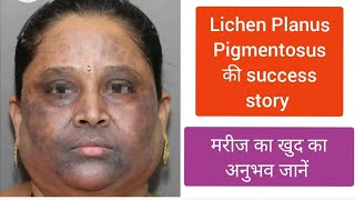 Lichen Planus Pigmentosus patient own experience LPP का इलाज lichenplanus LichenPlanusPigmentosus [upl. by Jeanelle111]