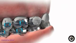 How to to Prevent Gum Soreness with Wax on Your Dental Braces  Scarborough ON [upl. by Airretnahs]