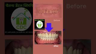 Before Treatment After Treatment drrahuljain chaitanyadental indoredentist dentaltreatment [upl. by Devan419]