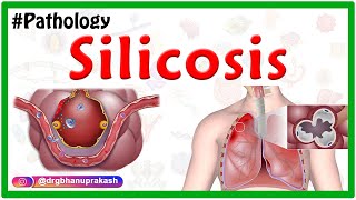 Silicosis Miners phthisis Grinders asthma  Etiology  Pathophysiology  Diagnosis Treatment [upl. by Anemolihp]