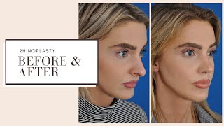 Plastic Surgery Before amp After  Rhinoplasty Nose Job  ESKMD NYC [upl. by Allimac]