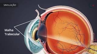 Tratamentos para o Glaucoma TRABECULECTOMIA [upl. by Eloisa]