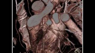 CardiacReimplantation of coronary artery following aortic root repair 4 of 5 [upl. by Stesha]