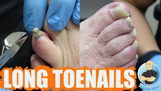 FUNGUS HUMONGUS  TRIMMING FUNGAL TOENAILS [upl. by Nnyllaf569]