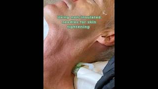 Best Skin Rejuvenation Treatment For Sagging Neck [upl. by Hendrickson573]