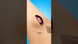 How Ganglion Cyst Removal Surgery Works shorts viralvideo [upl. by Nahtaj532]