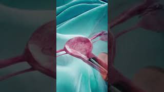 Hysteroscopy डिवाइस कैसा होता है Operative Hysteroscopy Procedure fibroid shorts animation [upl. by Anahsed]