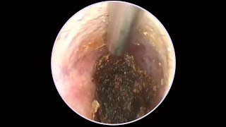 Tympanic membrane perforation and postoperative debridement for cholesteatoma 144 [upl. by Valentia687]