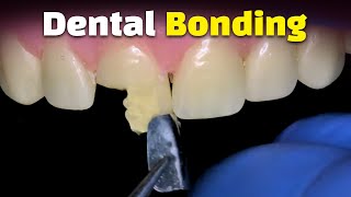 Front Tooth Bonding [upl. by Anitra]