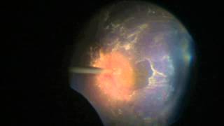 PAEDIATRIC RETINAL DETACHMENT USING TRIAMCINOLONE FOR PVD [upl. by Adina]