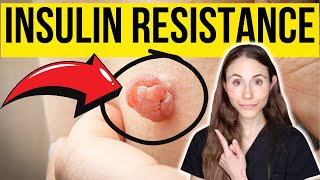 6 Warning Signs Of Insulin Resistance NOT TO MISS [upl. by Hebner429]