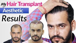 Unique Hair Transplant Results in India 2020  Grade III Baldness  Medispa Jaipur [upl. by Becht92]