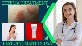 eczema treatment eczema causes and Ointment [upl. by Mairam]