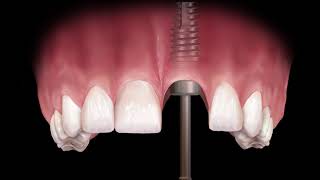 MultiPurpose Abutment to Fabricate a Custom Abutment [upl. by Ociral]