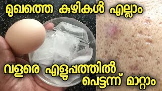 How to remove big pores from face naturally and easily  മുഖത്തെ കുഴികൾ എല്ലാം വളരെ വേഗം മാറ്റാം [upl. by Anialed945]