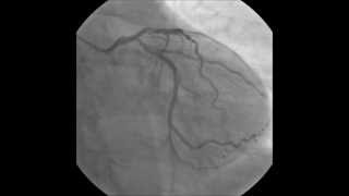 PCI RCA direct stenting with Nobori stent [upl. by Ellehcir108]