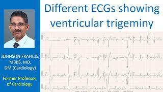 Different ECGs showing ventricular trigeminy [upl. by Ehav]