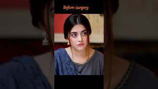 Alizey Shah Before after surgery 😱😳alizeyshah pakistanidramaactorsactressshortsfeedshortvideo [upl. by Odlonra804]