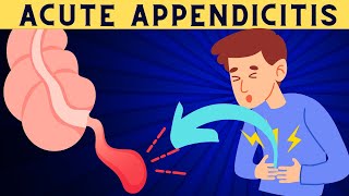 Acute Appendicitis Signs And Symptoms Risk Factors Diagnosis And Treatment [upl. by Fagan]