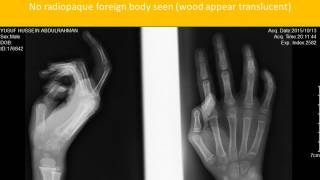 CASE 81 IMAGING WOOD SPLINTER FOREIGN BODY AT PALMAR SURFACE OF RIGHT HAND [upl. by Aneelad174]