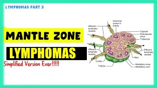 Mantle Zone Lymphoma Simplified  Speedy Medical [upl. by Ativla293]