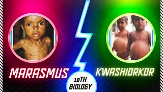 Marasmus and kwashiorkor nutritional deficiency diseases detailed explanation with pictures [upl. by Zorine]