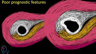 Early pregnancy ultrasound explained  GS  YS and FP [upl. by Haberman884]