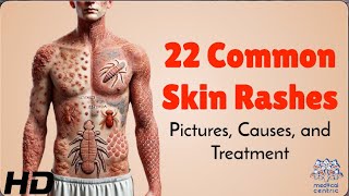 22 Skin Rashes Everyone Should Know About Symptoms amp Treatments [upl. by Kathye]