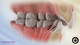 Deep Bite with Excessive Overjet  Dental Braces  Temecula Valley CA [upl. by Etteve694]