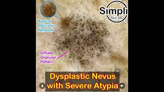 Severely Dysplastic Nevus Dermoscopy [upl. by Dryden]